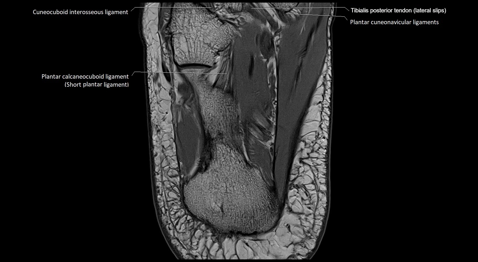 MRI ankle ligaments anatomy axial 3T image 26.webp